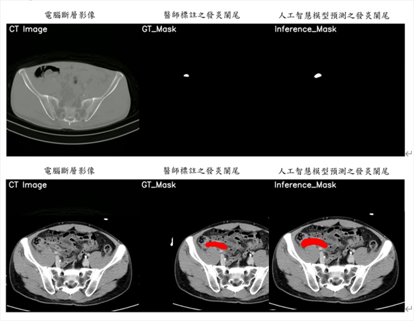 元智電機系攜手亞東影像醫學科團隊，使用電腦斷層掃描影像，進行判別是否發生急性闌尾...